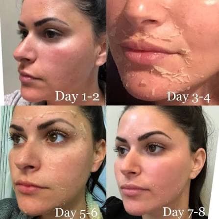 VI PEEL | 3 chemical peel at SKIN CLINIC in Laguna Hills, CA