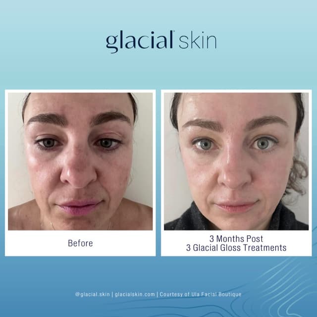 3 Glacial Gloss Treatment at SKIN CLINIC in Laguna Hills, CA