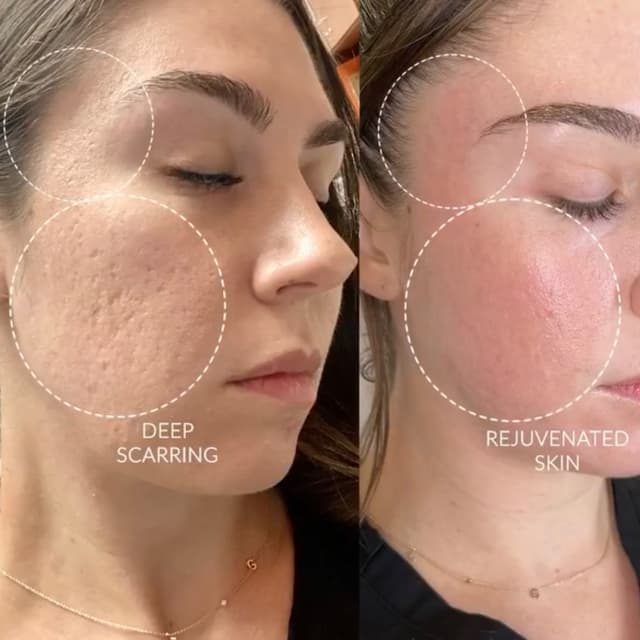 5 Glacial Glide Add-Ons at SKIN CLINIC in Laguna Hills, CA