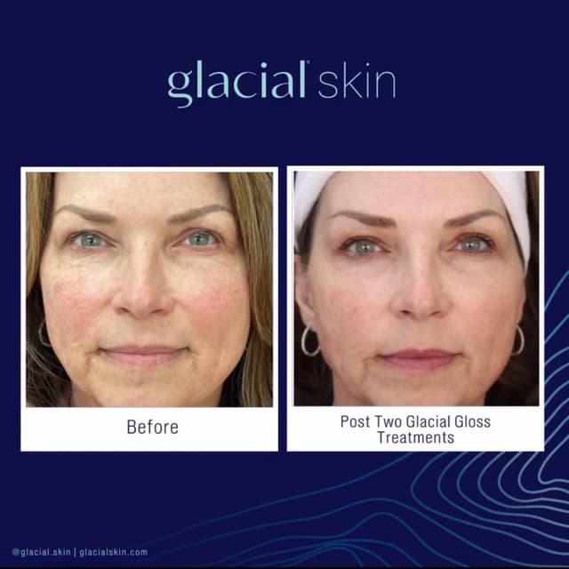 5 Glacial Gloss Treatment at SKIN CLINIC in Laguna Hills, CA