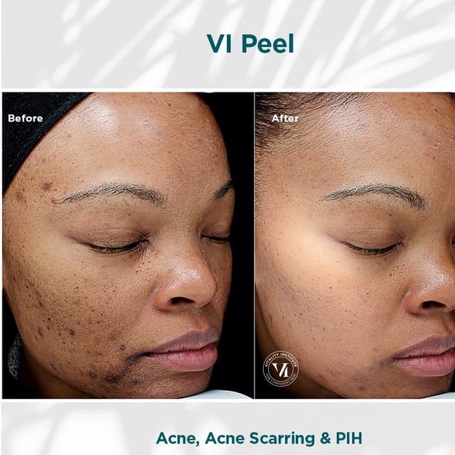 VI PEEL | 6 chemical peel at SKIN CLINIC in Laguna Hills, CA