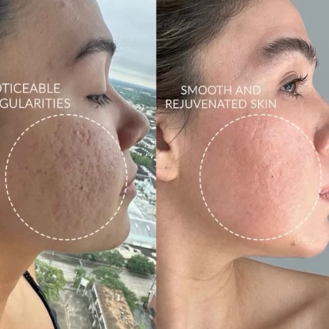 3 Glacial Glide Add-Ons at SKIN CLINIC in Laguna Hills, CA
